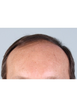 Before Hair Transplant&nbsp;Front